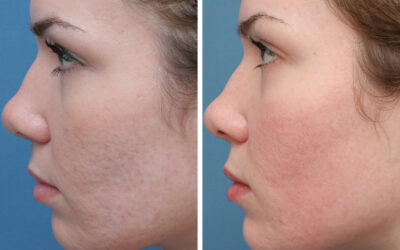 Complete Acne and Scars Treatment at kotil Skin Science