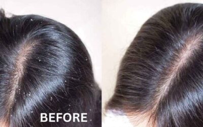 How to Cure Dandruff Permanently: Kotil Skin Science