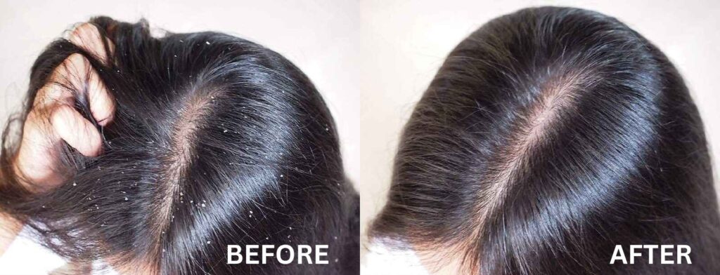 How to Cure Dandruff Permanently: Kotil Skin Science
