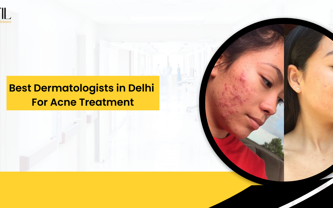 best acne treatment Delhi