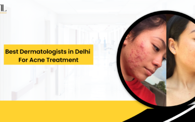 Best Dermatologists in Delhi for Acne Treatment