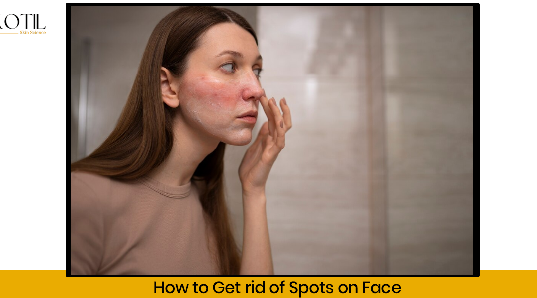 How to get rid of spots on face