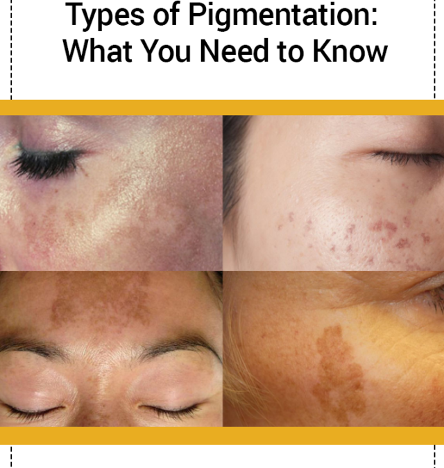 Understanding Different Types of Pigmentation: What You Need to Know