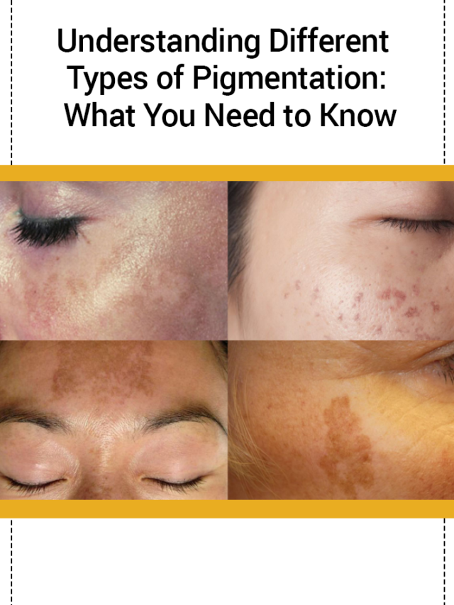 Understanding Different Types of Pigmentation: What You Need to Know