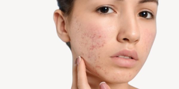 Acne Scar Treatment In Delhi