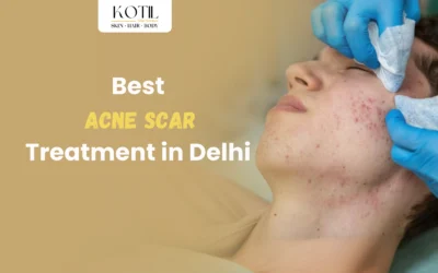 Everything To Know About Best Acne Scar Treatment In Delhi India