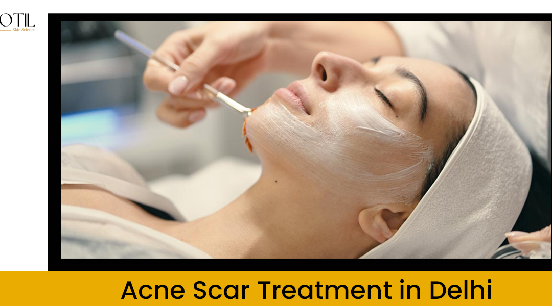 Everything To Know About Best Acne Scar Treatment In Delhi India