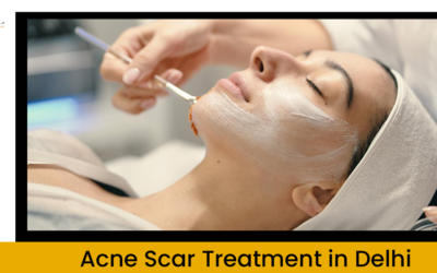 Everything To Know About Best Acne Scar Treatment In Delhi India