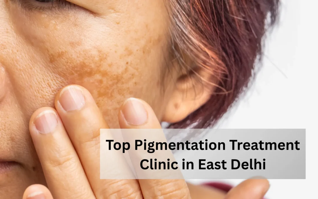 Top Pigmentation Treatment Clinic in East Delhi