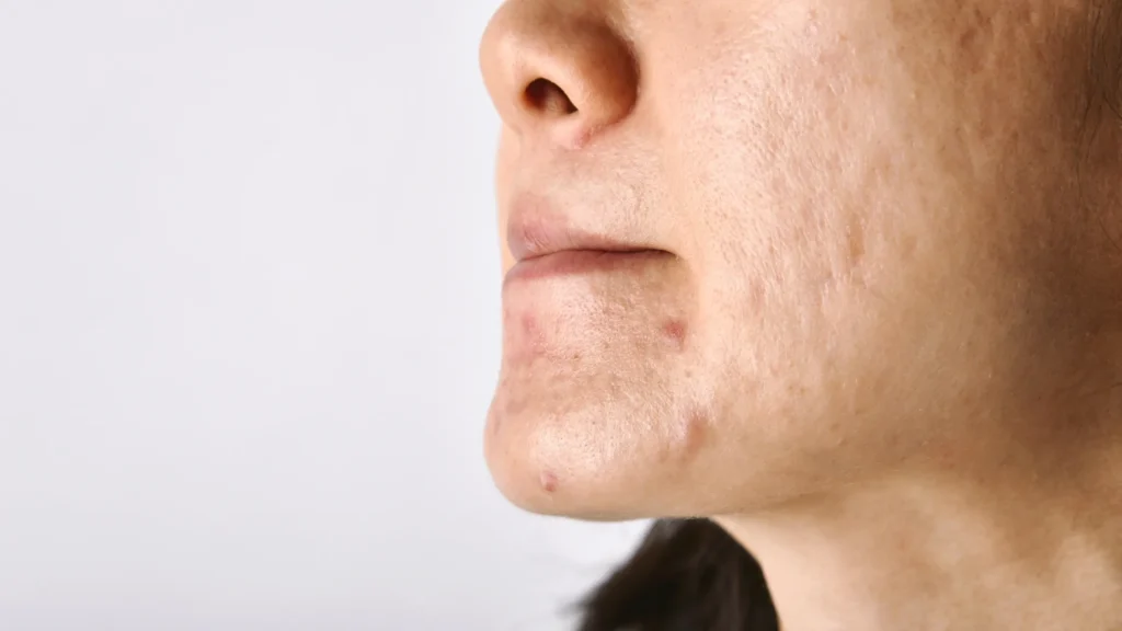 Top Pigmentation Treatment Clinic in East Delhi