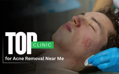 Top Clinic for Acne Removal Near Me