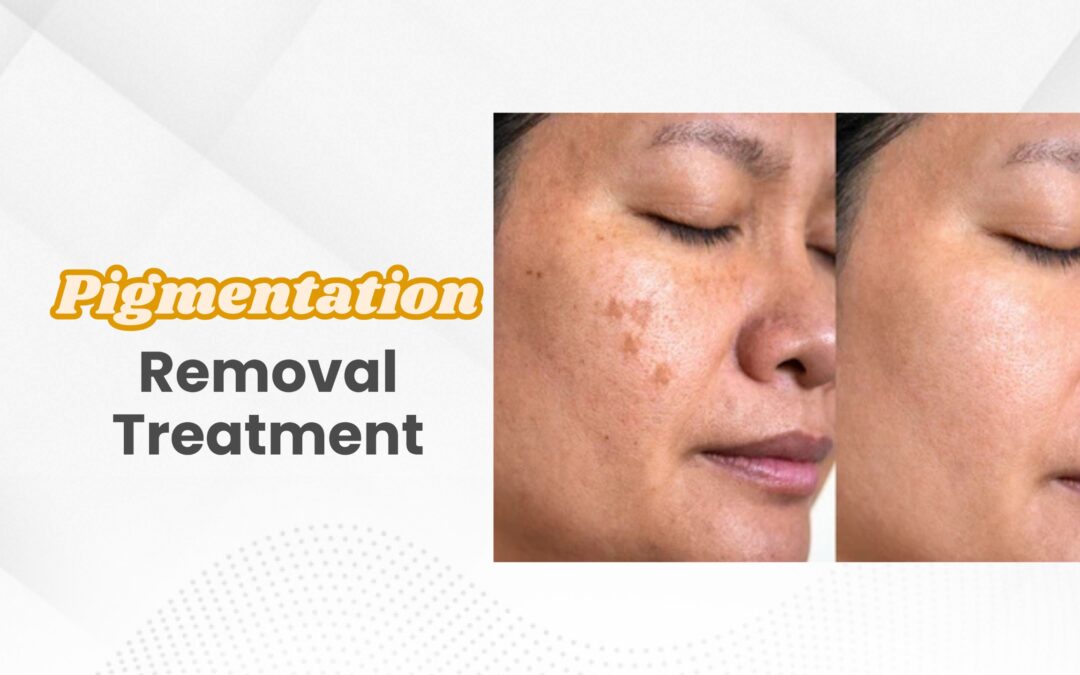 Pigmentation Removal Treatment 2025