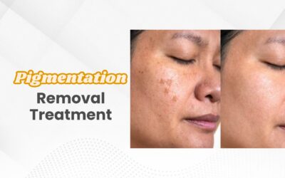 Pigmentation Removal Treatment 2025