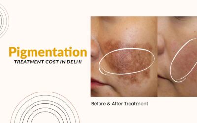 Pigmentation Treatment Cost in Delhi 2025: What You Need to Know