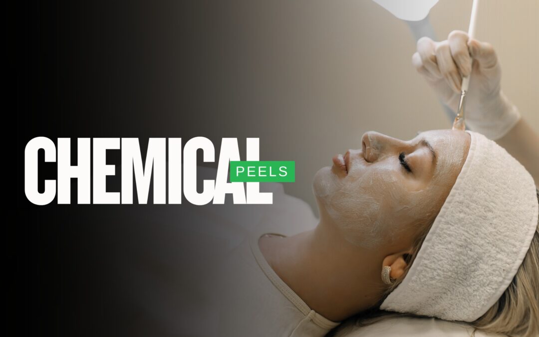 Chemical Peels: A Proven Solution for Radiant, Even Skin 2025