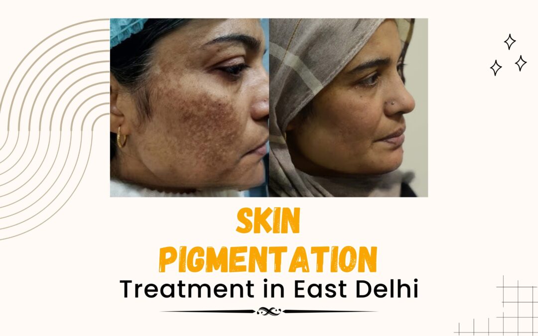 Skin Pigmentation Treatment in East Delhi: Your Complete Guide 2025
