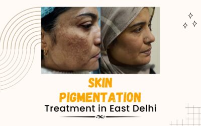 Skin Pigmentation Treatment in East Delhi: Your Complete Guide 2025