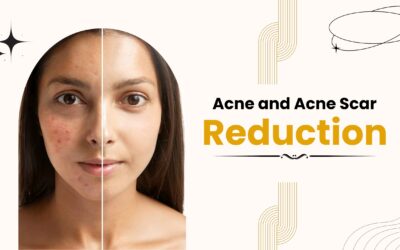Acne and Acne Scar Reduction 2025 at Kotil Skin Science