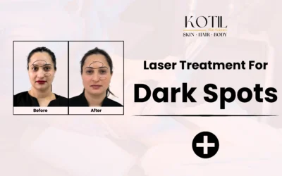 Laser Treatment for Dark Spots 2025: A Complete Guide to Clearer Skin | Kotil Skin Science