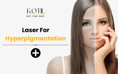 Laser for Hyperpigmentation 2025: The Modern Solution for Clear, Even Skin | Kotil Skin Science