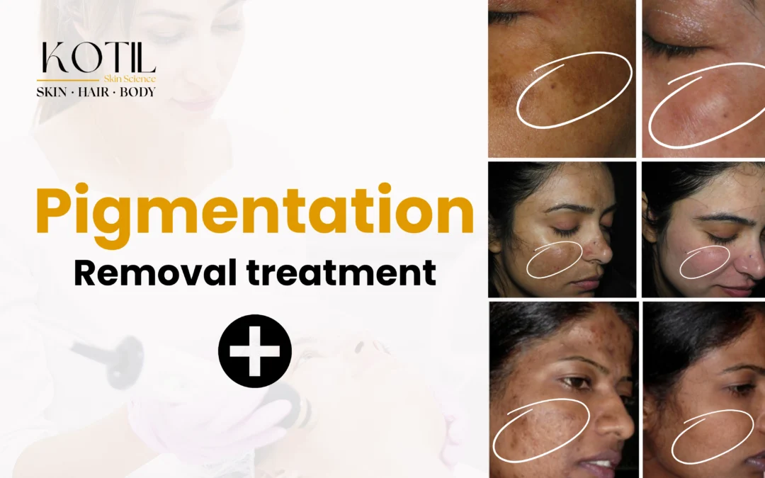 pigmentation removal treatment
