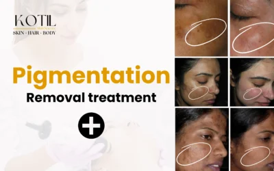 Pigmentation Removal Treatment 2025 | Glowing Skin | Kotil Skin Science