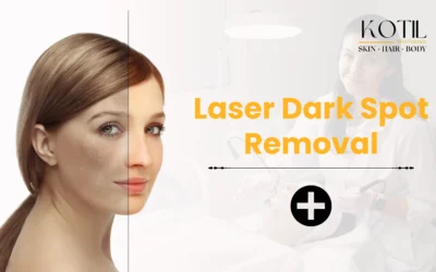 Laser Dark Spot Removal 2025: The Modern Solution for Clear, Even Skin