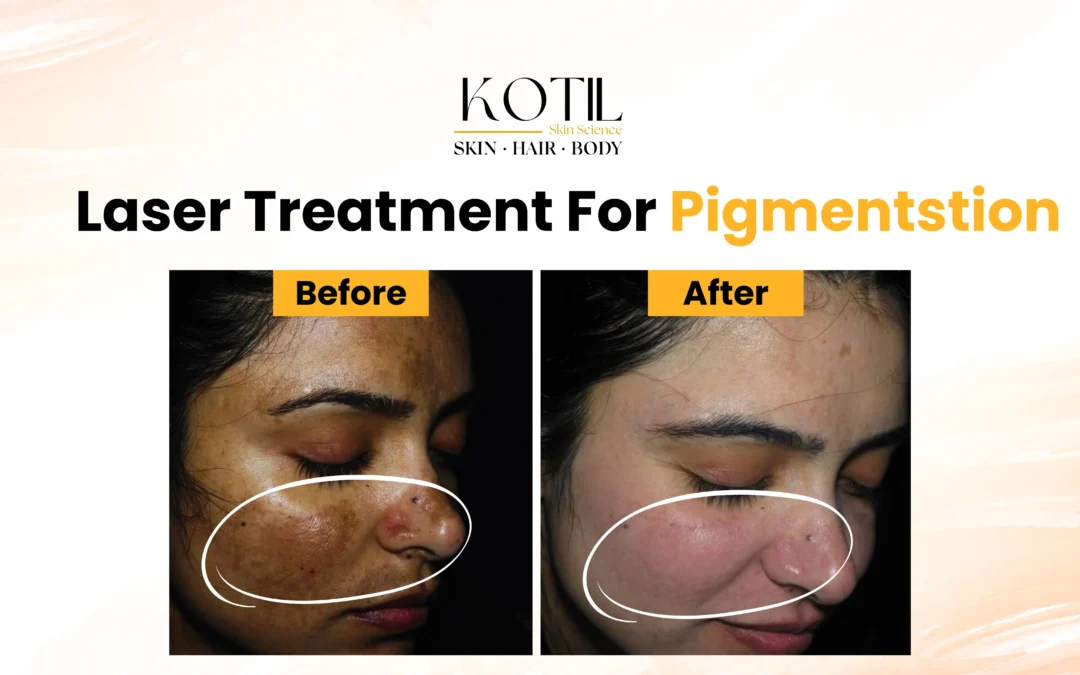 Laser Treatment for Pigmentation 2025: Guide to Clear, Even-Toned Skin | Kotil Skin Science