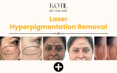 Laser Hyperpigmentation Removal 2025: Advanced Guide to Clearer, Brighter Skin | Kotil Skin Science