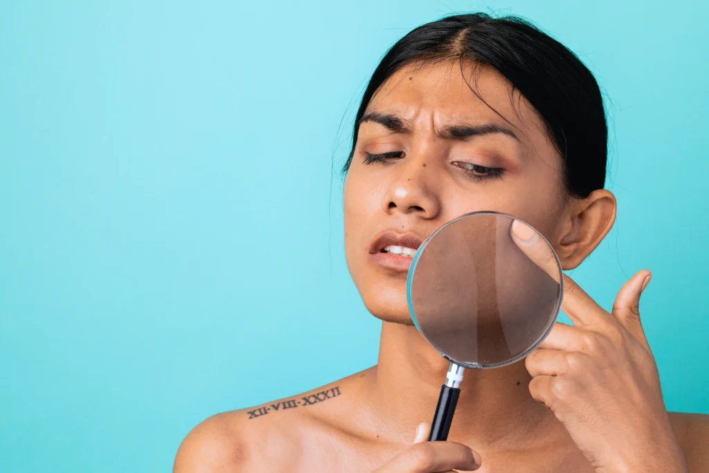 What causes hyperpigmentation in the first place?