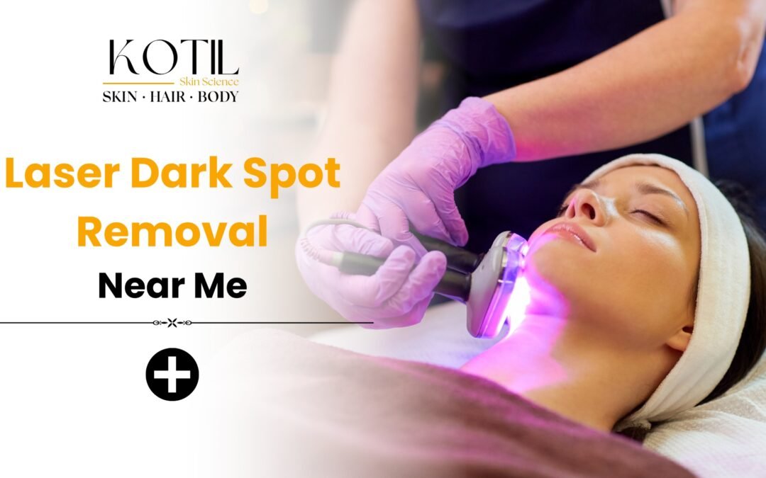 Laser dark spot removal treatment at Kotil Skin Science Delhi using advanced Nd:YAG technology