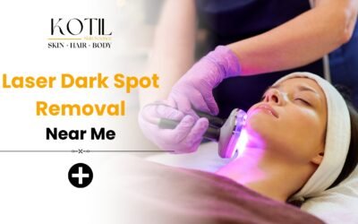 Laser dark spot removal – Kotil Skin Science Delhi)