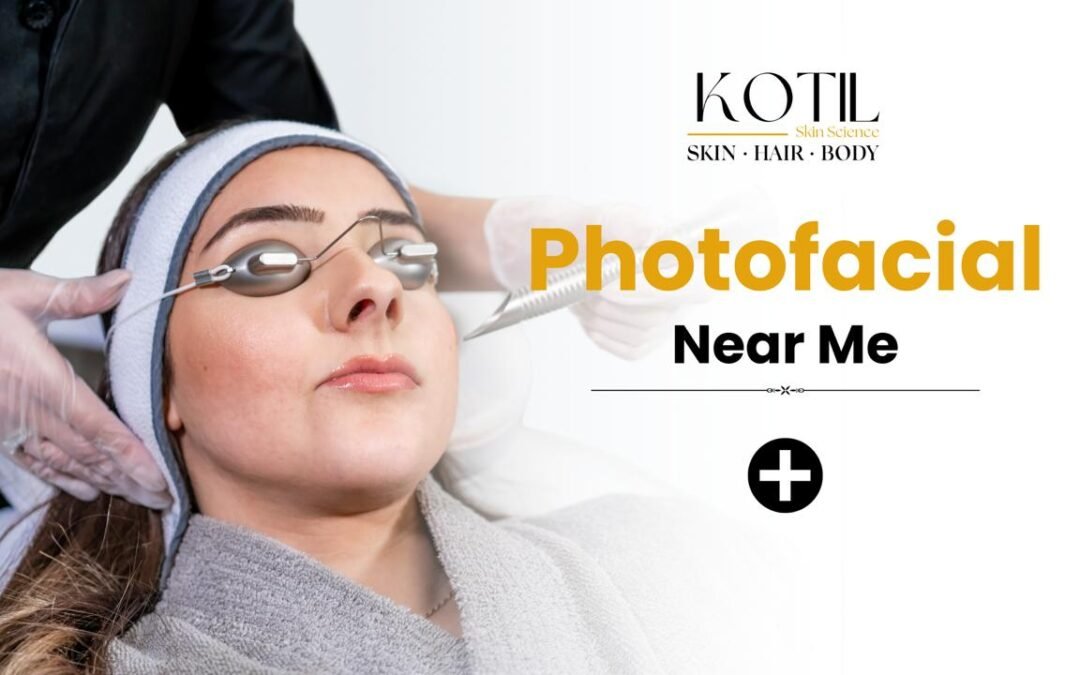 Photofacial treatment near me at Kotil Skin Science