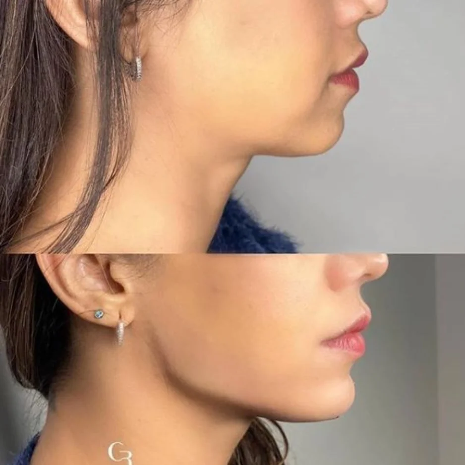 Chin Implant