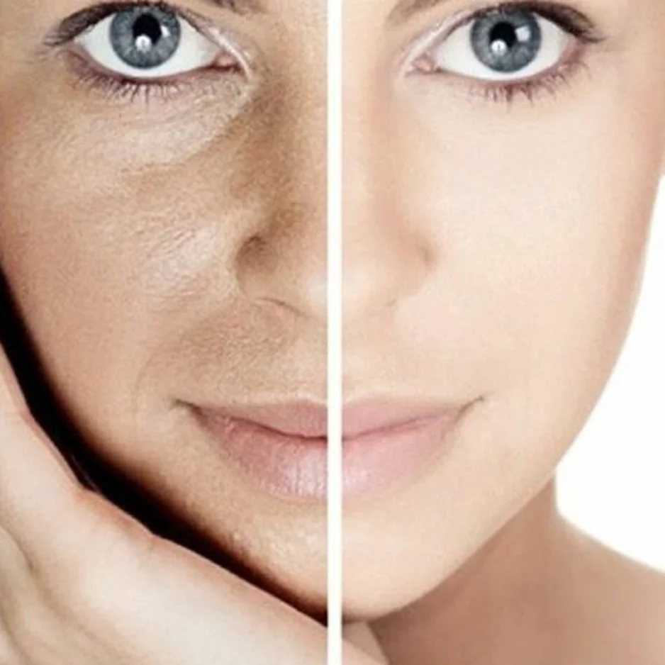 Normal Dry Dehydration