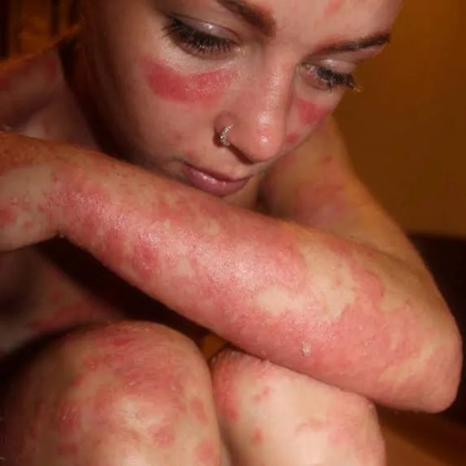 Psoriasis Eczema