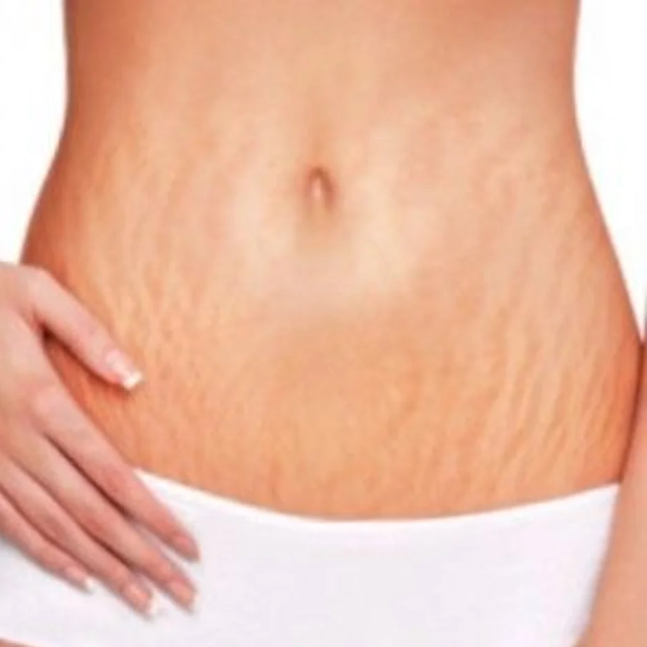 Stretch Marks