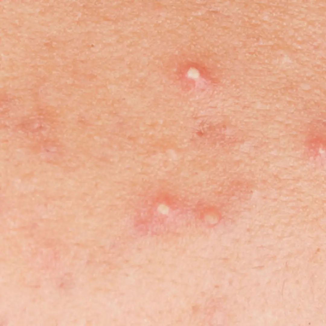 Whiteheads Removal Treatment