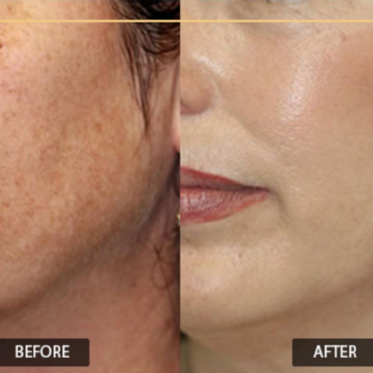 WhatsApp Image 2025-12-17 at 5.34.59 PM Advanced Laser Toning Treatment in Delhi | Kotil Skin Science