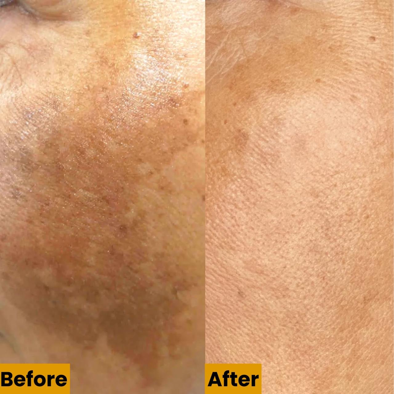 Advanced Laser Toning Treatment in Delhi | Kotil Skin Science Advanced Laser Toning Treatment in Delhi | Kotil Skin Science