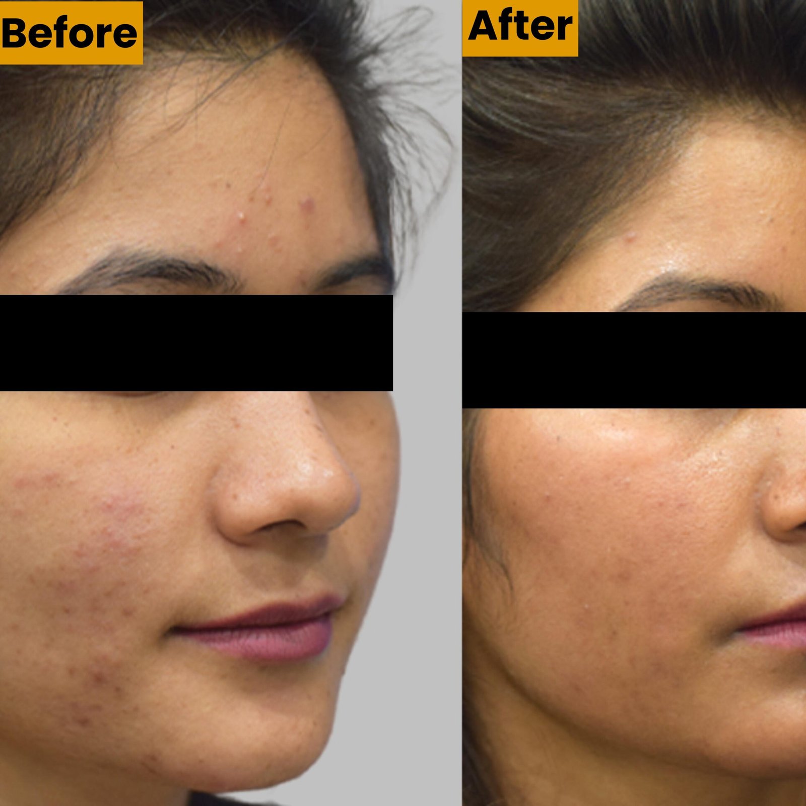 Advanced Laser Toning Treatment in Delhi | Kotil Skin Science Advanced Laser Toning Treatment in Delhi | Kotil Skin Science