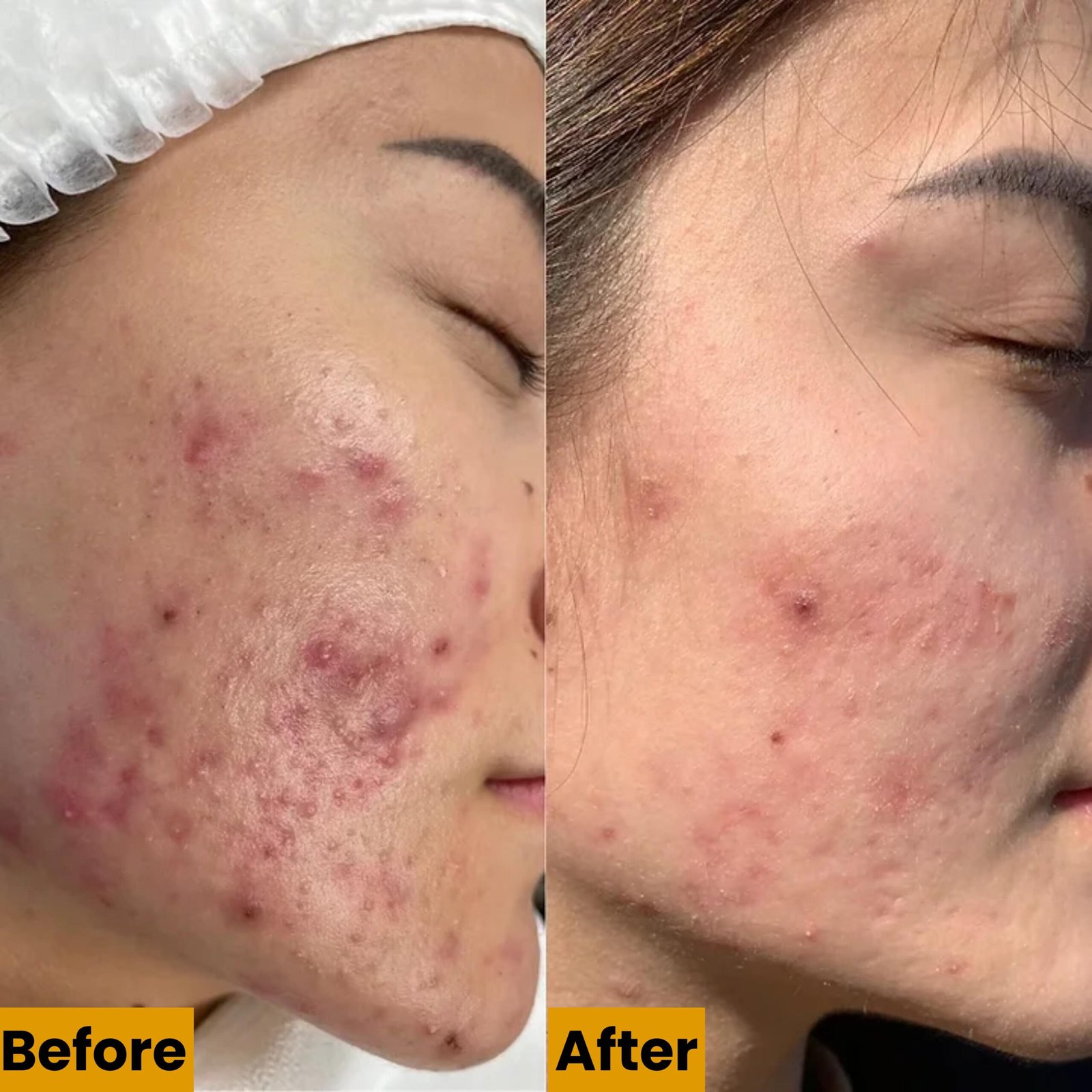 WhatsApp Image 2025-12-17 at 5.54.43 PM (2) Advanced Laser Toning Treatment in Delhi | Kotil Skin Science