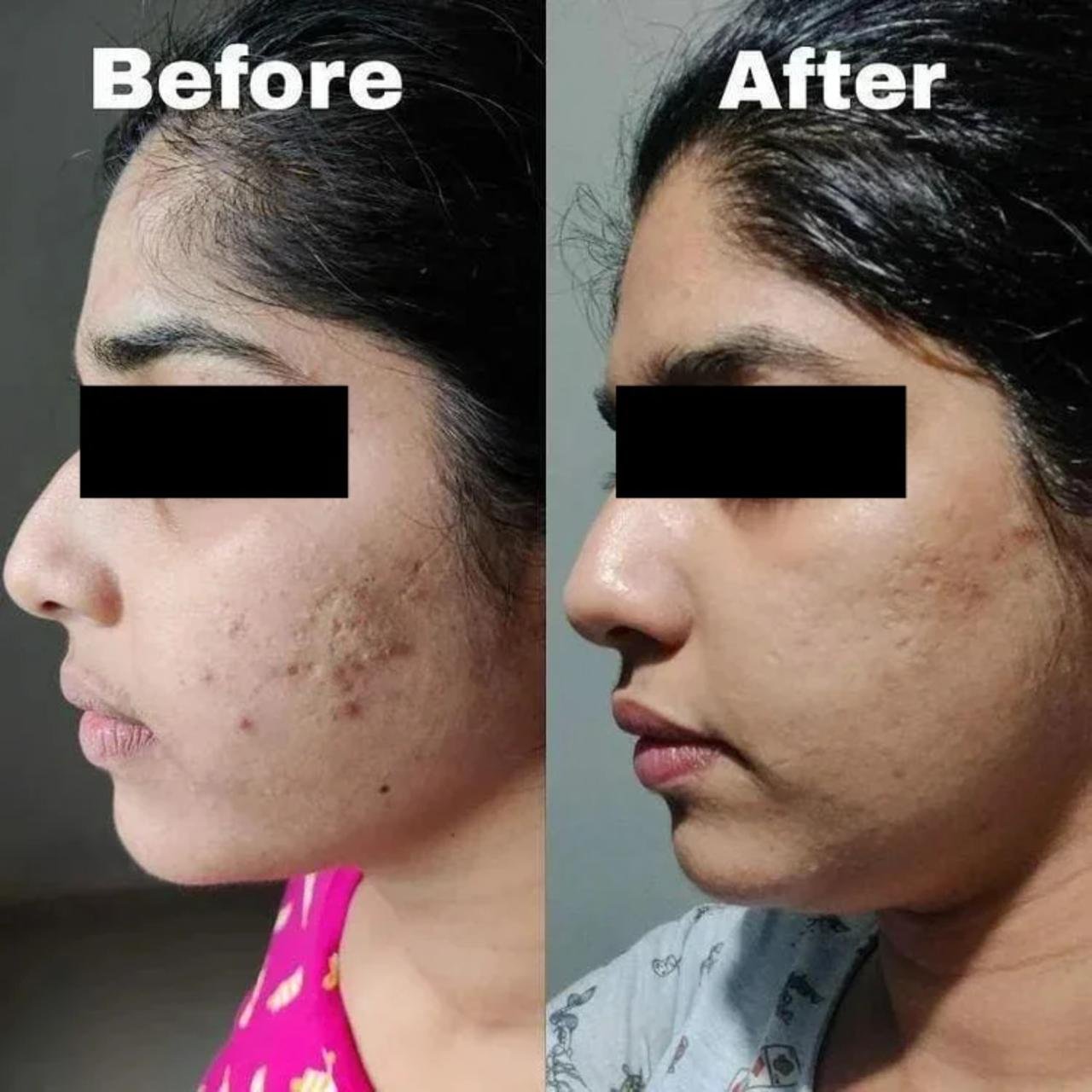Advanced Laser Toning Treatment in Delhi | Kotil Skin Science Advanced Laser Toning Treatment in Delhi | Kotil Skin Science