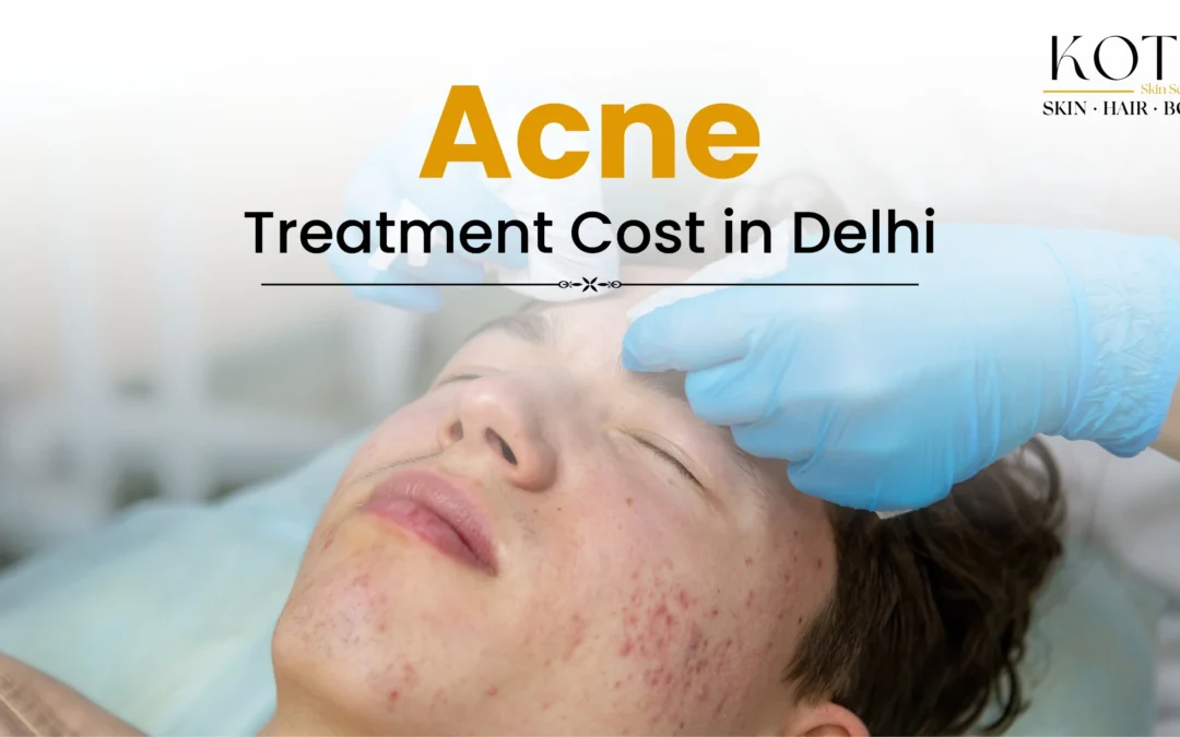Acne Treatment Cost in Delhi – Kotil Skin Science