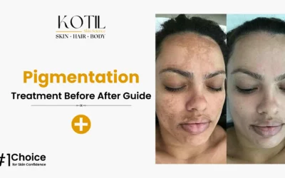 Pigmentation Treatment Before After Guide – Kotil Skin Science