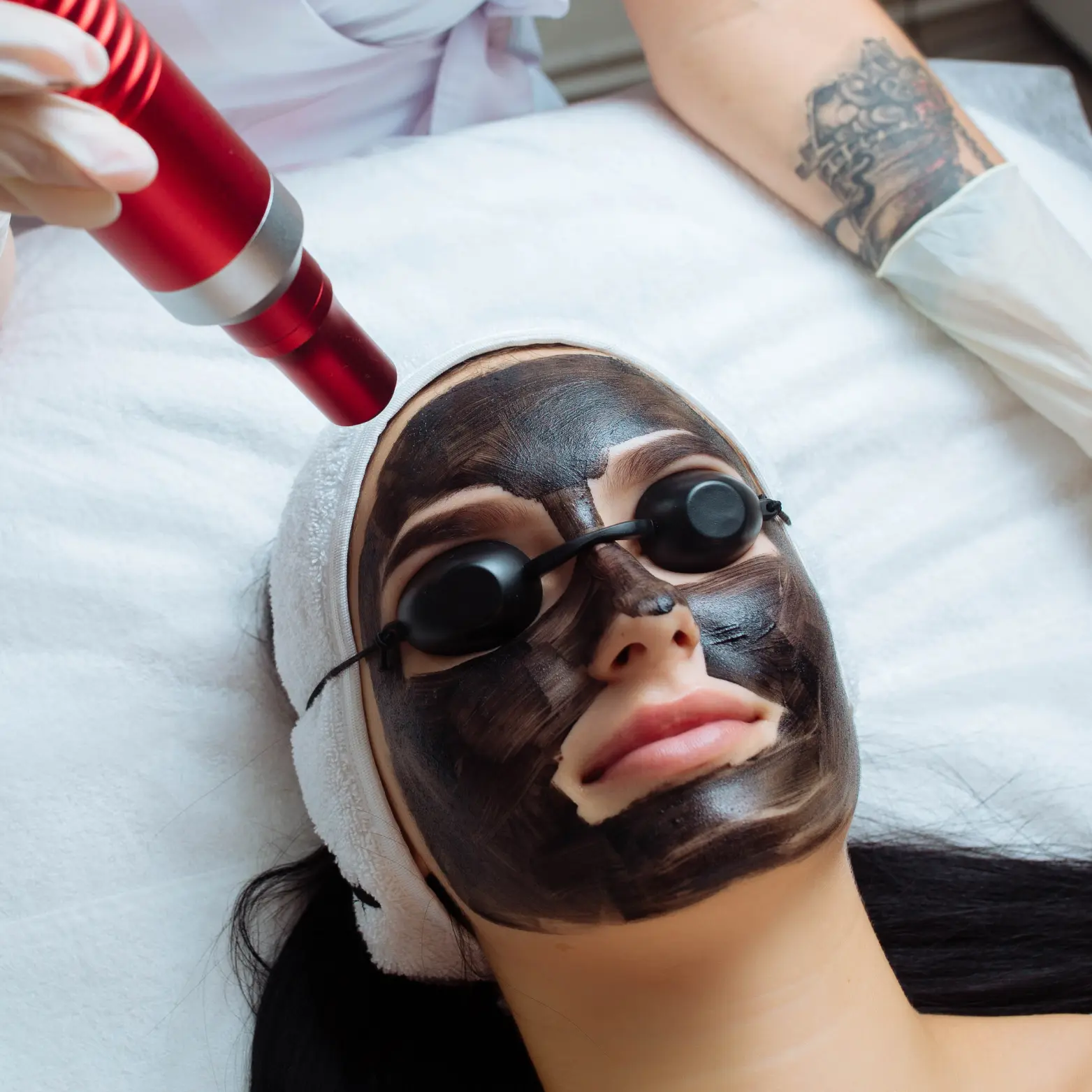 Carbon Laser Peel Treatment | Kotil Skin Science