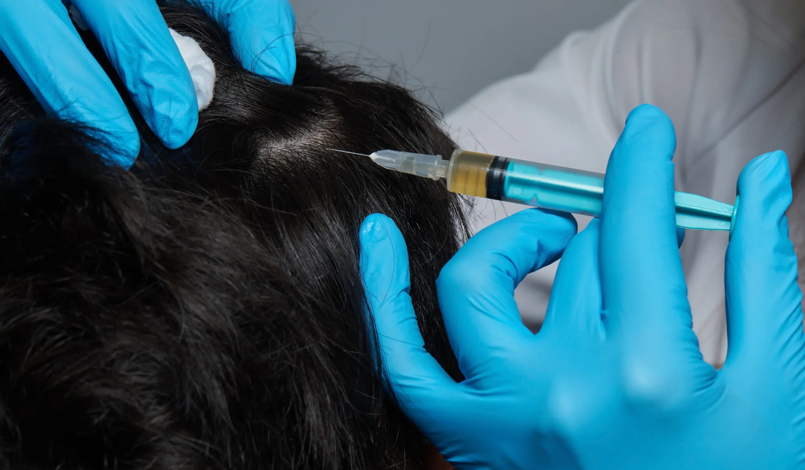 PRP Hair Regrowth
