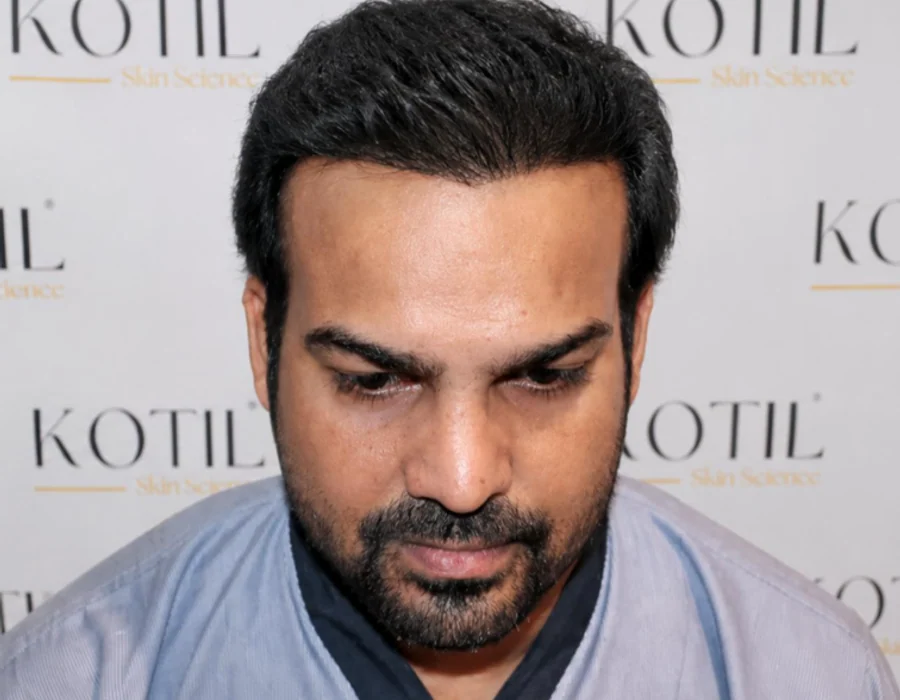 Scalp treated for hair thinning