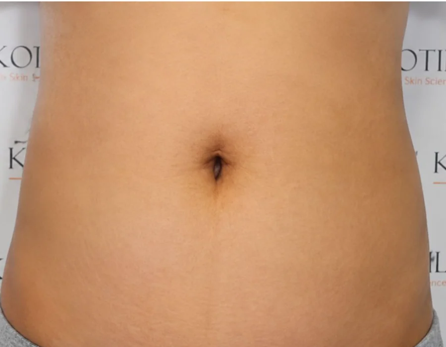 Abdomen treated for stretch marks