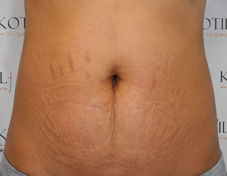 Stretchmarks Before